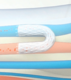 stent tek image
